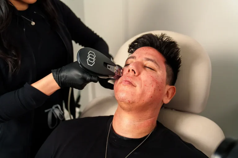 Man receives Morpheus8 facial treatment in Santa Ana med spa for skincare rejuvenation